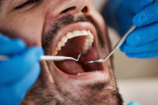Best Emergency Tooth Extraction in Desnso, CA